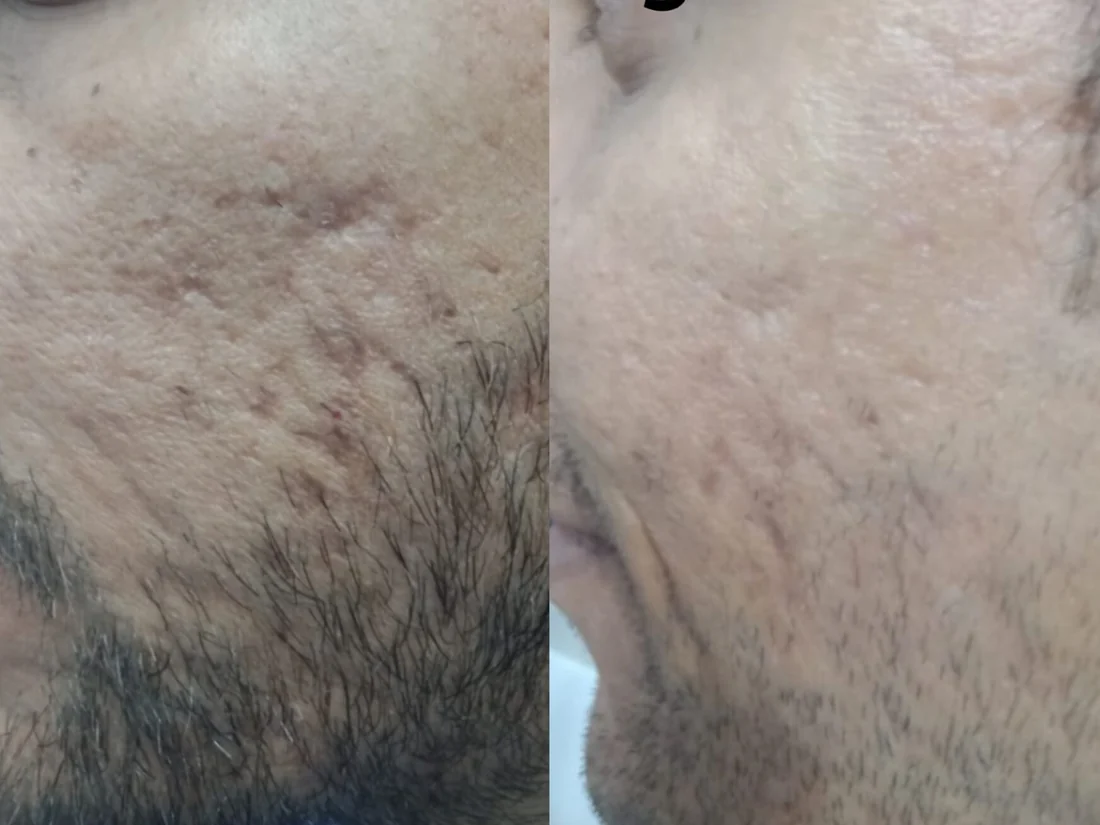 Acne scar treatment before and after, fractional CO2 laser, Beyond Beauty Clinic Vehari