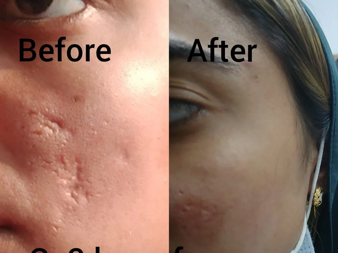 Acne scar before and after with CO2 laser, female patient, Vehari clinic