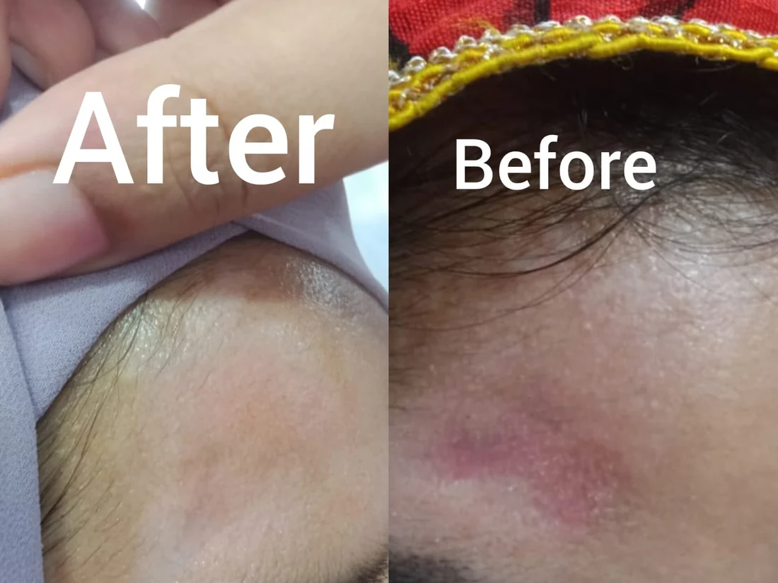 Forehead inflammation before and after medical treatment, Beyond Beauty Vehari