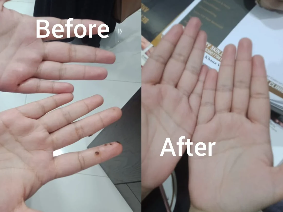 Pigmented lesion removal on fingers, before and after, Vehari clinic