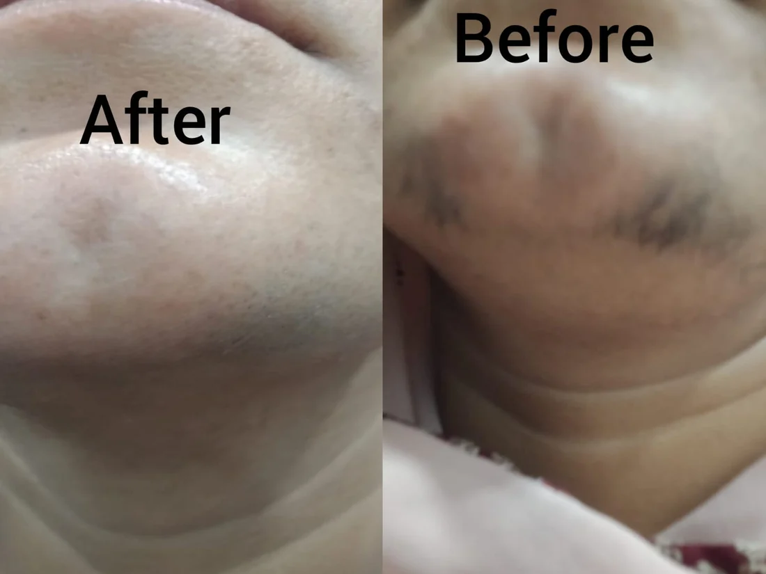 Neck and chin pigmentation before and after, Beyond Beauty Clinic Vehari