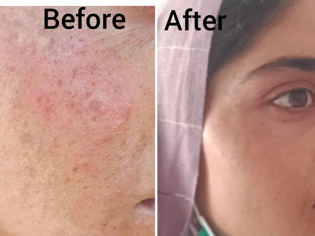 Pigmentation and post-acne marks before and after treatment, Vehari