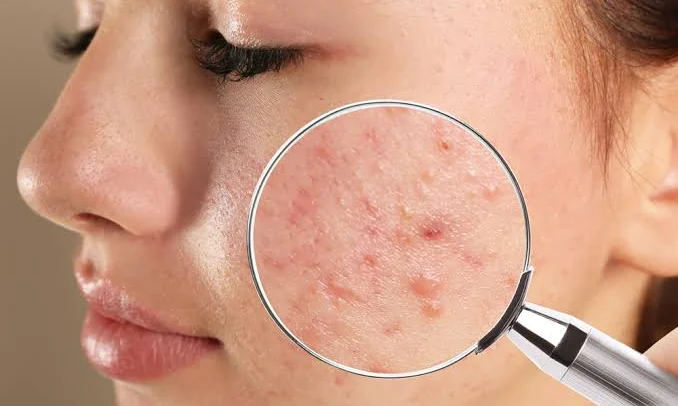 Close examination of acne-affected skin at Beyond Beauty Skin, Laser and Aesthetic Clinic, Vehari