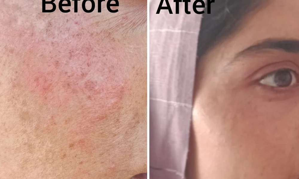 Pigmentation treatment result at Beyond Beauty Clinic, Vehari